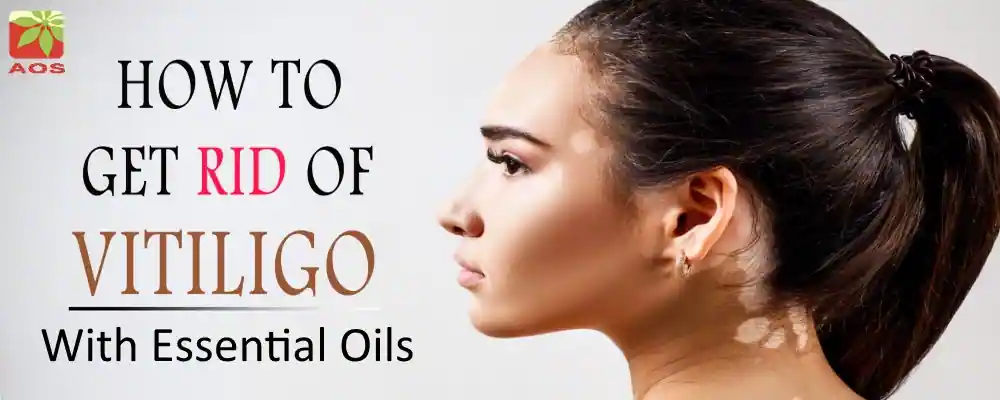 Essential Oils for Vitiligo