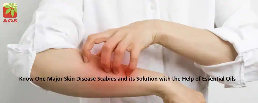 Essential Oils for Scabies