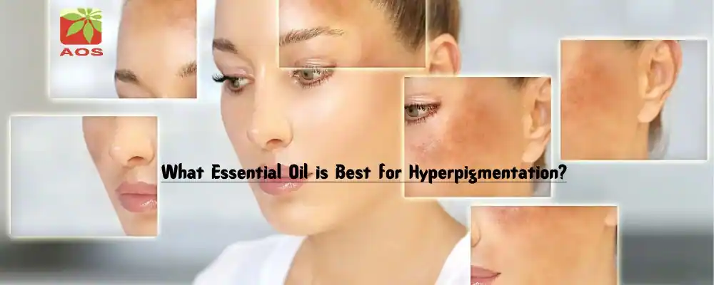 Essential Oils for Hyperpigmentation