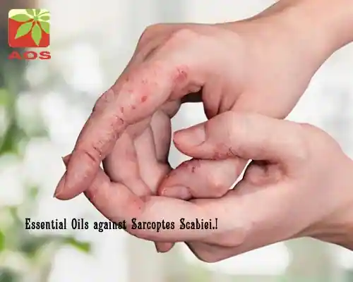 Essential Oils for Scabies