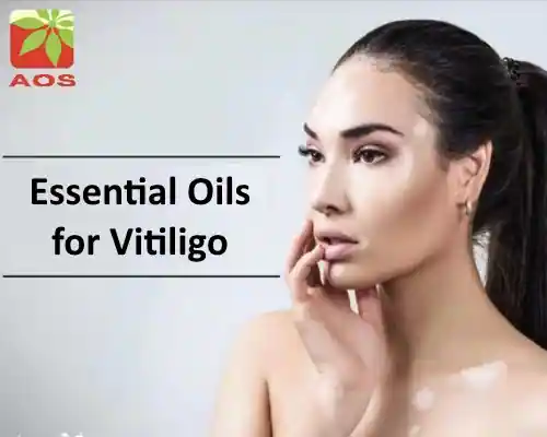 Essential Oils for Vitiligo