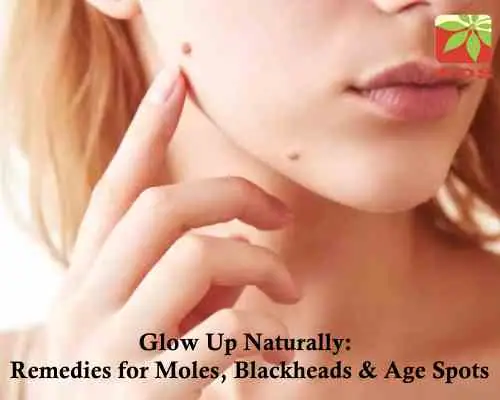 Remedies for Moles Blackheads and Age Spots