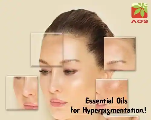 Essential Oils for Hyperpigmentation